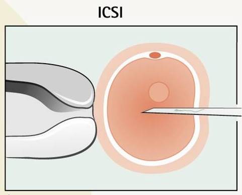 ICSI.jpg