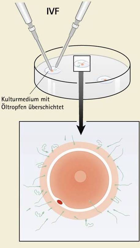 ivf.jpg