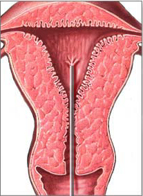 gewebeprobe_uterus.png